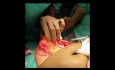 Chirurgie conservatrice du sein (mastopexie en bloc rond) pour le cancer du sein