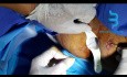 Fistule Anale Laser