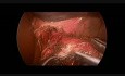 Cardiomyotomie de Heller par voie coelioscopique chez un patient de 16 ans