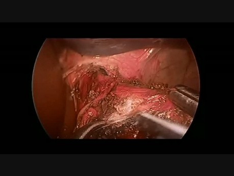 Cardiomyotomie de Heller par voie coelioscopique chez un patient de 16 ans