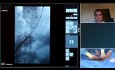 Réintervention sur Anévrysme de l'Aorte Abdominale Récurrent avec le Système "Stent-Graft" Endurant IIs