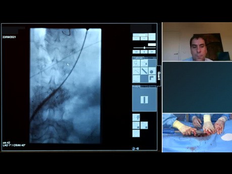 Réintervention sur Anévrysme de l'Aorte Abdominale Récurrent avec le Système "Stent-Graft" Endurant IIs