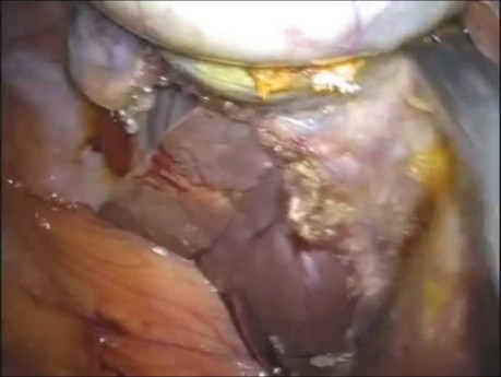 Cholécystectomie Laparoscopique par Incision Unique (LESS) sans Anesthésie Générale