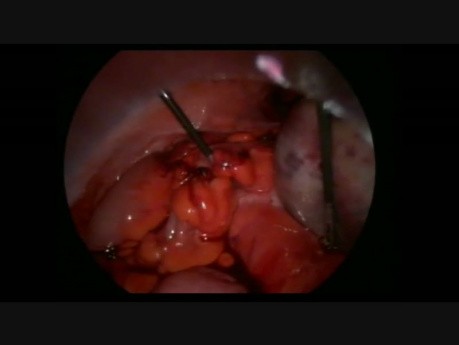 Torsion d'annexe avec un kyste - intervention laparoscopique