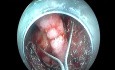 Lésion Plate Légèrement Déprimée au Centre, Résection Combinée Mucosectomie/Dissection Sous-Muqueuse