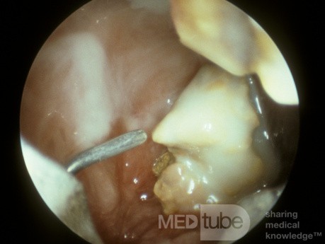 Fistule oroantrale [vue sinuscopique]