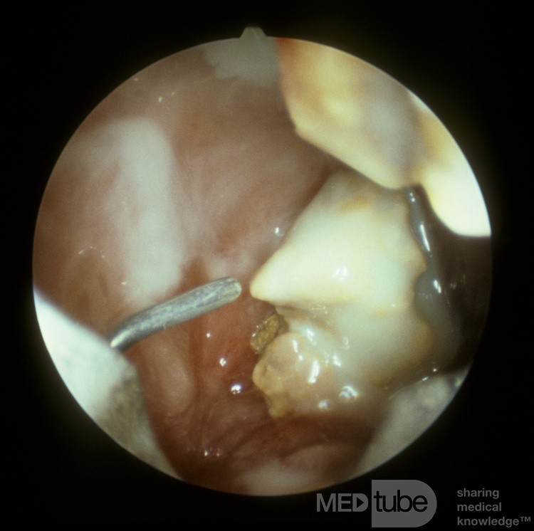 Fistule oroantrale [vue sinuscopique]