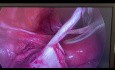 Kystectomie Coelioscopique de l'Ovaire Gauche et Adhésiolyse