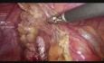Appendicectomie Laproscopique 