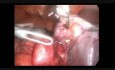 Grossesse extra-utérine abdominale - prise en charge laparoscopique