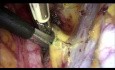L'hystérectomie radicale laparoscopique de type B avec isolement de la tumeur cervicale