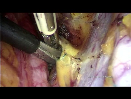 L'hystérectomie radicale laparoscopique de type B avec isolement de la tumeur cervicale