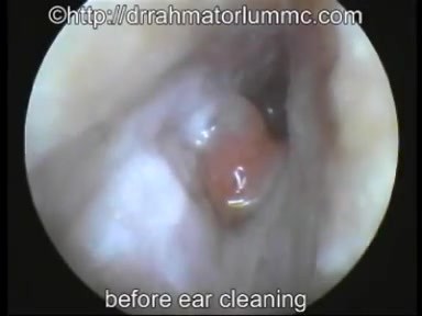 Un polype inflammatoire du passage de l'oreille - Dégagement d'aspiration