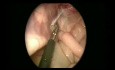 Pyloromyotomie laparoscopique et suture de l'anneau inguinal percutané chez un bébé de 47 jours
