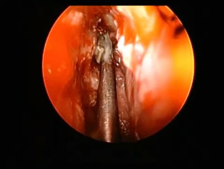 Chirurgie Draf IIb 