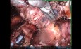 Tumeur Bronchique d'Accès Difficile