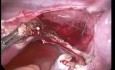 Exérèse de la corne utérine rudimentaire non communicante par voie laparoscopique à la 19e semaine de grossesse