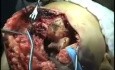 Arthroplastie du Coude pour Fracture Intercondylienne Distale de l'Humérus