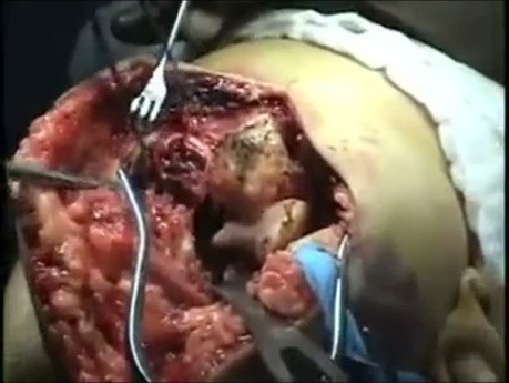 Arthroplastie du Coude pour Fracture Intercondylienne Distale de l'Humérus
