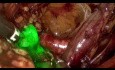 vNOTES du Ganglion Sentinelle pour le Cancer de l'Endomètre
