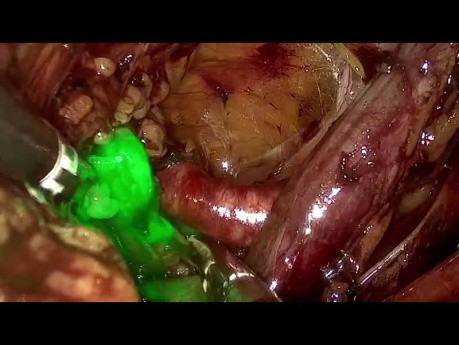 vNOTES du Ganglion Sentinelle pour le Cancer de l'Endomètre