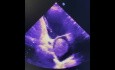 14. Cas d'échocardiographie - Qu'est ce que vous voyez ?