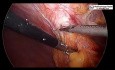 Réparation d'une hernie incisionnelle sous-costale par laparoscopie