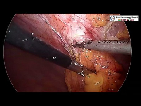 Réparation d'une hernie incisionnelle sous-costale par laparoscopie