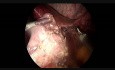 Gastrectomie Sleeve en cas d'Echec de l'Anneau Gastrique