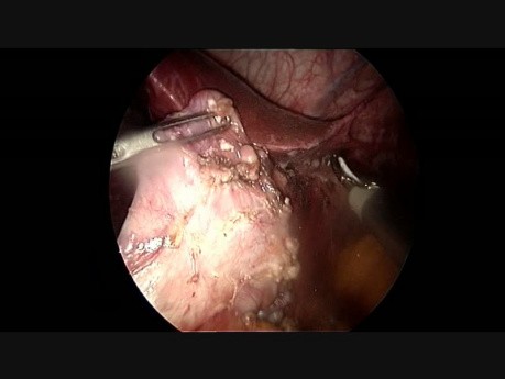 Gastrectomie Sleeve en cas d'Echec de l'Anneau Gastrique