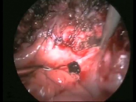 Importance de la suture dans la gestion des complications de la chirurgie laparoscopique 