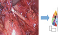 Bisegmentectomie Droite S1+S3 Mini-Invasive ( Peu Commune )