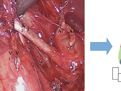 Bisegmentectomie Droite S1+S3 Mini-Invasive ( Peu Commune )