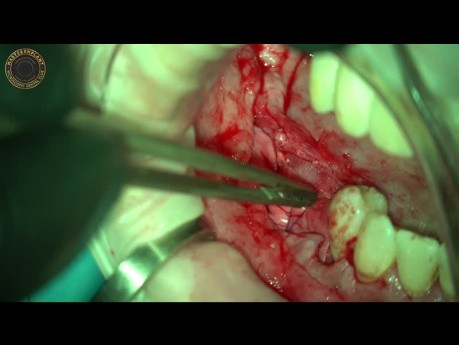 Reconstruction osseuse mandibulaire avec bloc osseux