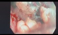 Mucosectomie endoscopique du polype rectal