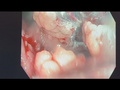 Mucosectomie endoscopique du polype rectal