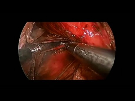 Fundoplicature de Toupet par Cœlioscopie