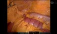 Résection Robotisée de l'Intestin Grêle pour Invagination