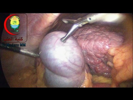 Cholécystectomie Laparoscopique sur Cholangiocarcinome