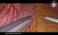 Technique de Gastrectomie Laparoscopique Sleeve