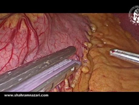 Technique de Gastrectomie Laparoscopique Sleeve
