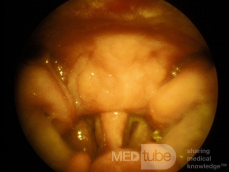 Sarcoïdose du toit du nasopharynx