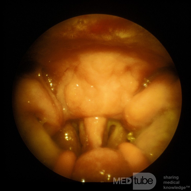 Sarcoïdose du toit du nasopharynx