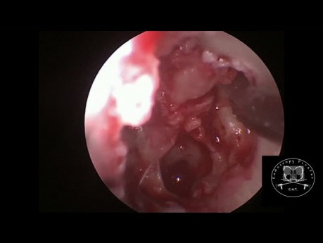 Tympanoplastie endoscopique pour cholestéatome