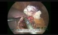 Kysto-gastrostomie laparoscopique pour un pseudokyste pancréatique