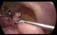 Conversion Laparoscopique de la Gastrectomie Sleeve en Bypass Roux en Y avec Réparation d'une Hernie Hiatale