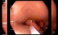 Lésion Colique Adaptée à l’Endoscopie ou à la Chirurgie - Que faire ? 