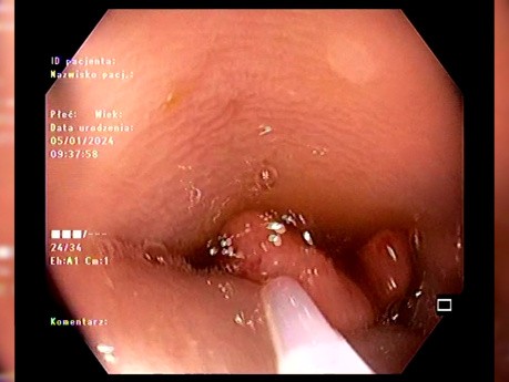 Lésion Colique Adaptée à l’Endoscopie ou à la Chirurgie - Que faire ? 