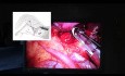 Insertion d'une agrafeuse au cours d'une lobectomie par vidéo-thoracoscopie uniportale