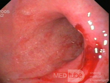 La gastrite chronique active - vue endoscopique.